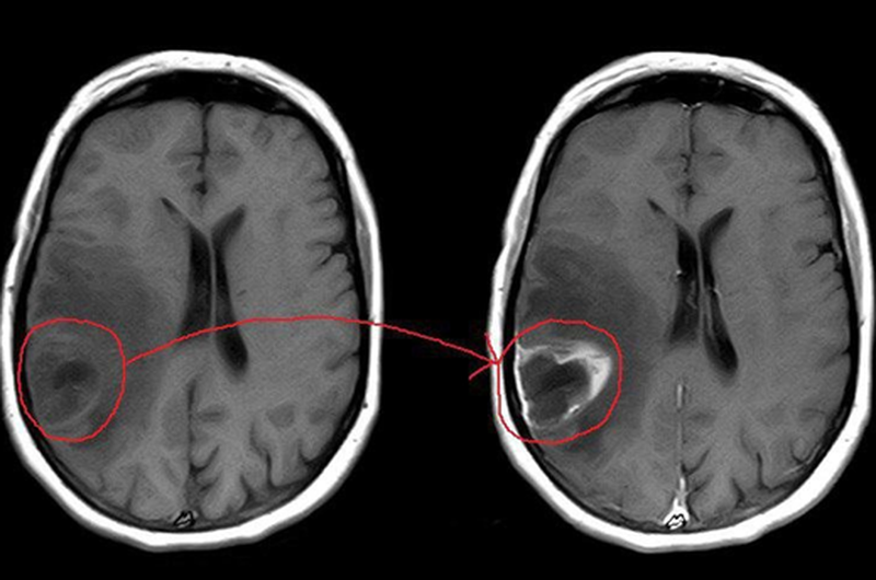 Опухоль головного мозга на МРТ