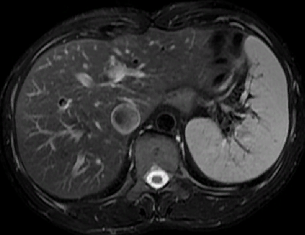 Магнитно-резонансная томография органов брюшной полости, норма