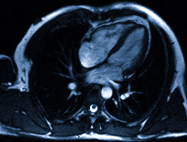МР-скан на уровне сердца