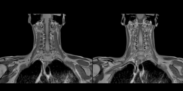 Снимки МРТ мягких тканей шеи