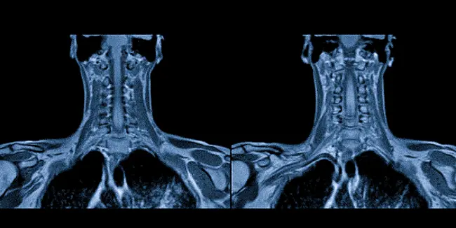 Снимки МРТ мягких тканей шеи