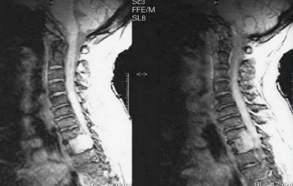 Метастазы на снимках МРТ шеи