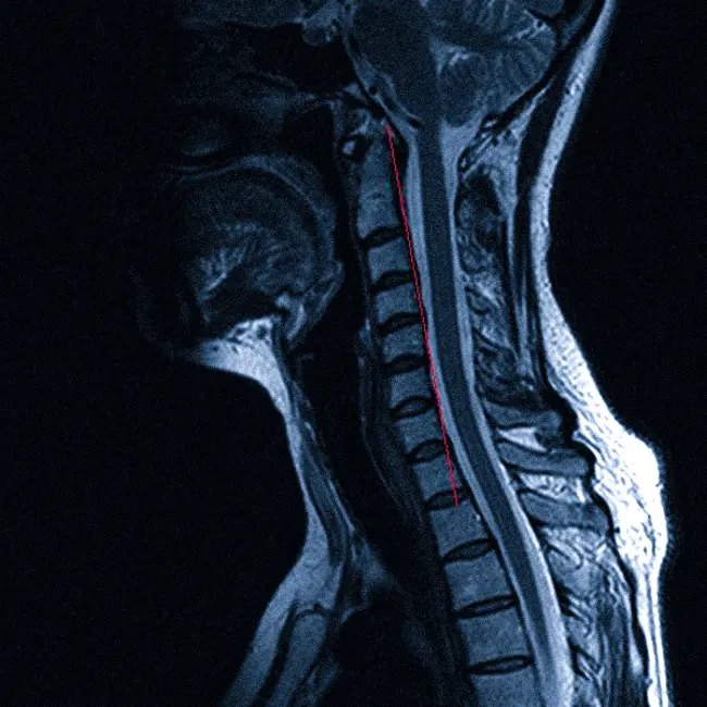 МРТ шейного отдела позвоночника