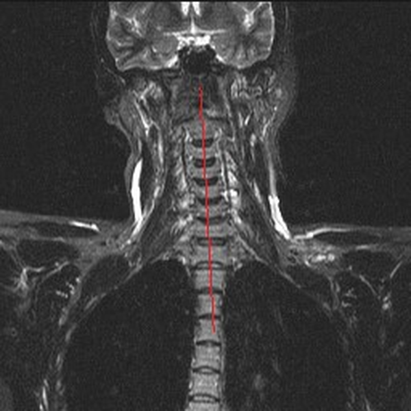 МРТ шеи: оценка сколиоза