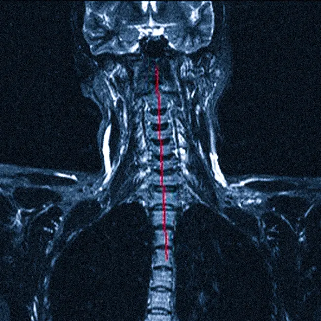 МРТ шеи: оценка сколиоза