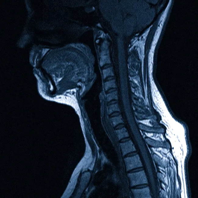 шейный отдел позвоночника на МРТ