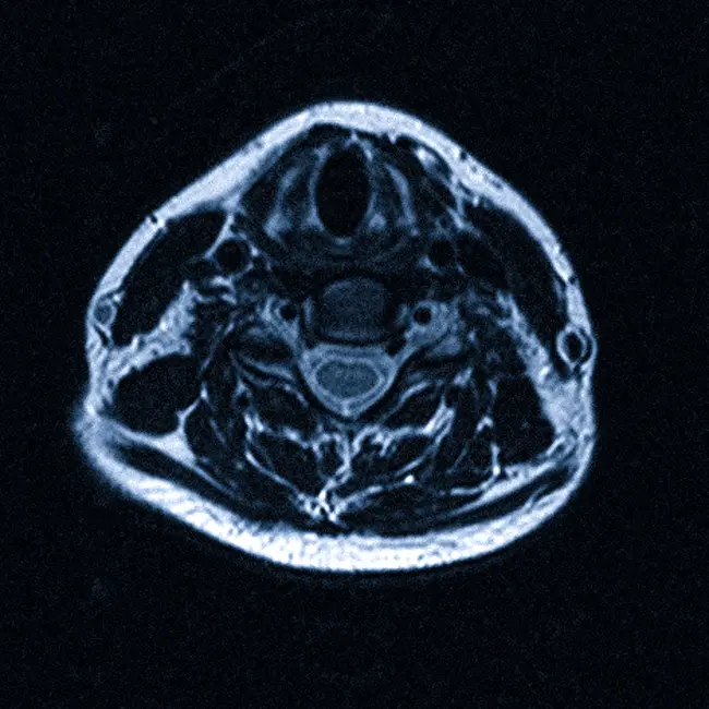МРТ шейного отдела позвоночника что показывает