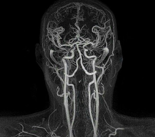МР-ангиография головы и шеи