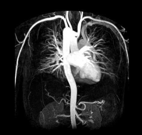 Магнитно-резонансная артериография средостения
