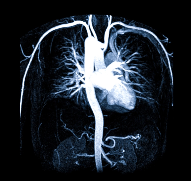 Магнитно-резонансная артериография средостения