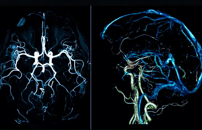 МРТ сосудов головного мозга