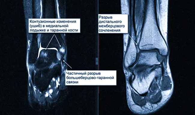 Патологии стопы на МРТ
