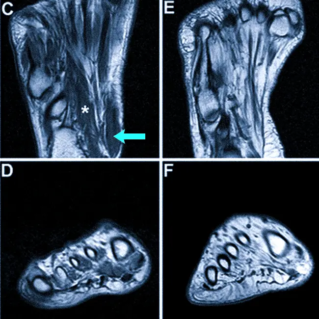 МРТ стопы, что показывает?