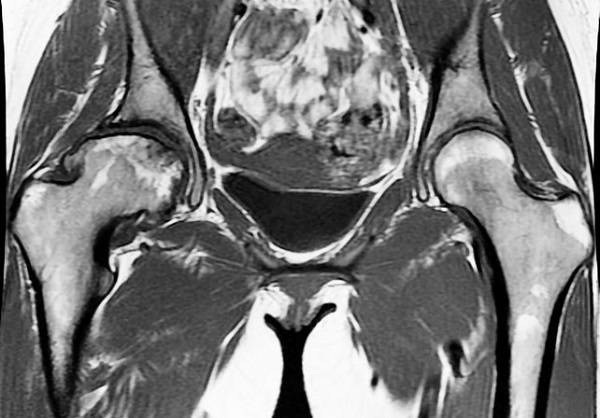 Артрит правого тазобедренного сустава на снимке МРТ