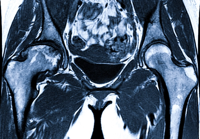 Артрит правого тазобедренного сустава на снимке МРТ
