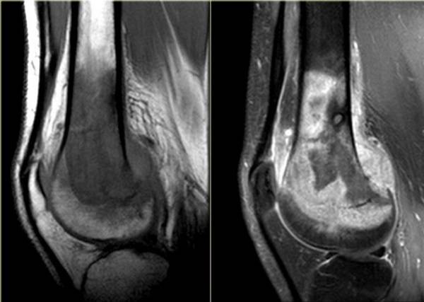 Остеосаркома коленного сустава на МРТ