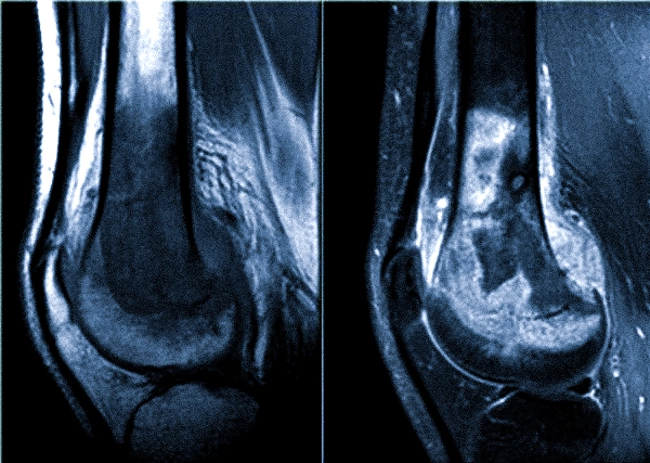 Остеосаркома коленного сустава на МРТ