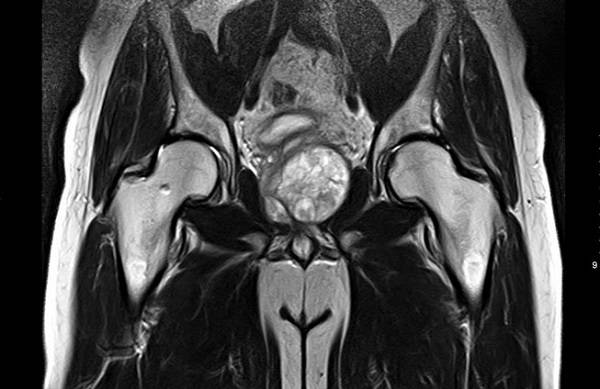 Магнитно-резонансное сканирование тазобедренных суставов