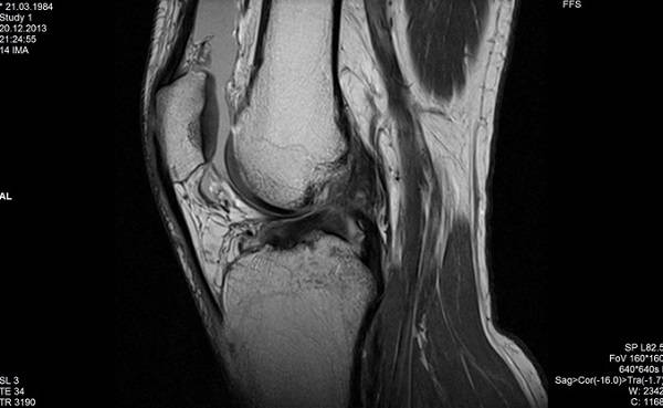 МРТ коленного сустава, разрыв передней крестообразной связки