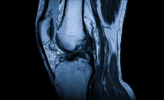 МРТ коленного сустава, разрыв передней крестообразной связки