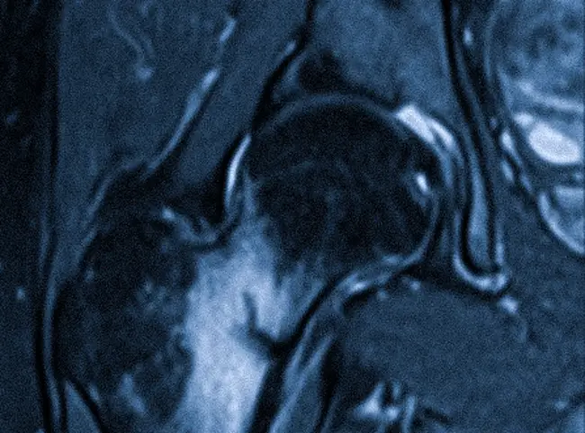 Стресс-перелом шейки бедра на МРТ