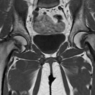 МРТ тазобедренного сустава что показывает