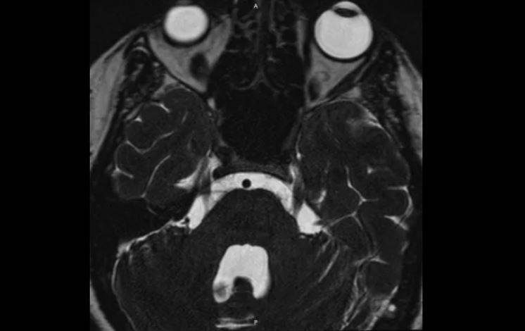 На снимке МРТ визуализируется сдавление тройничного нерва верхней мозжечковой артерией (нейроваскулярный конфликт)