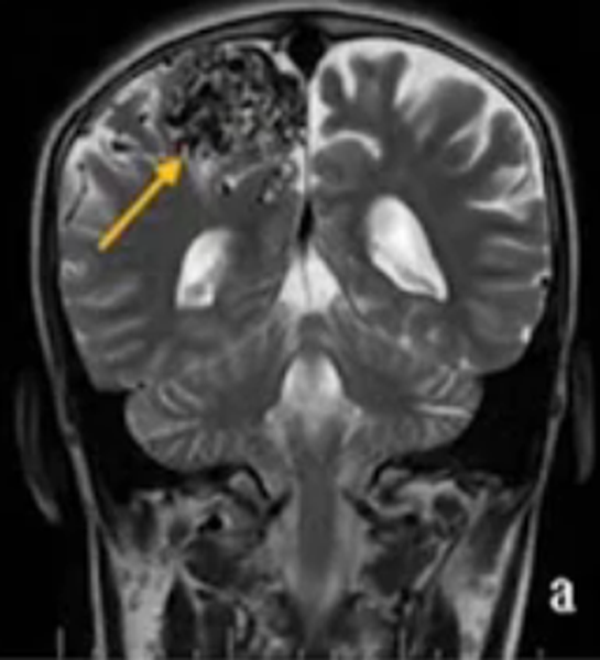 Артерио-венозная мальформация на МРТ головного мозга
