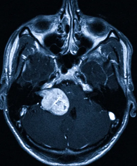 Невринома слухового нерва на МРТ