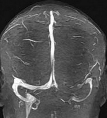 Гипоплазия поперечного синуса справа на МР-снимках головы