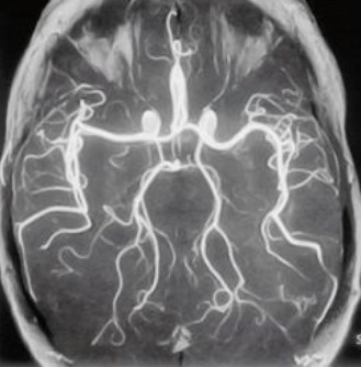Фото магнитно-резонансного исследования церебральных сосудов