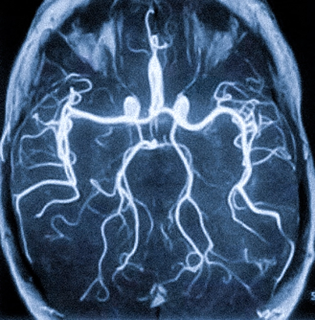 Фото магнитно-резонансного исследования церебральных сосудов
