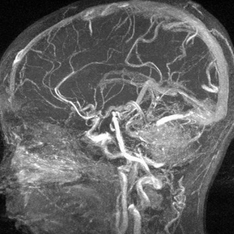 МРТ вен головного мозга, что показывает