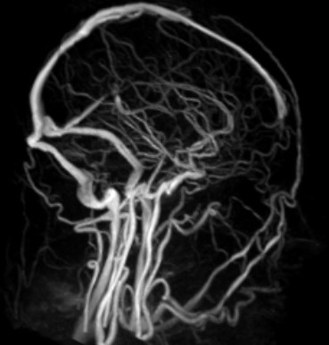 МР-сканирование сосудов головы