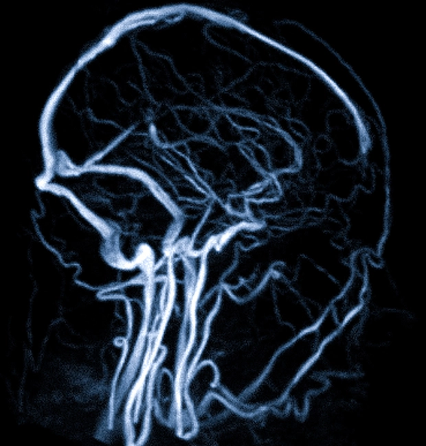 МР-сканирование сосудов головы