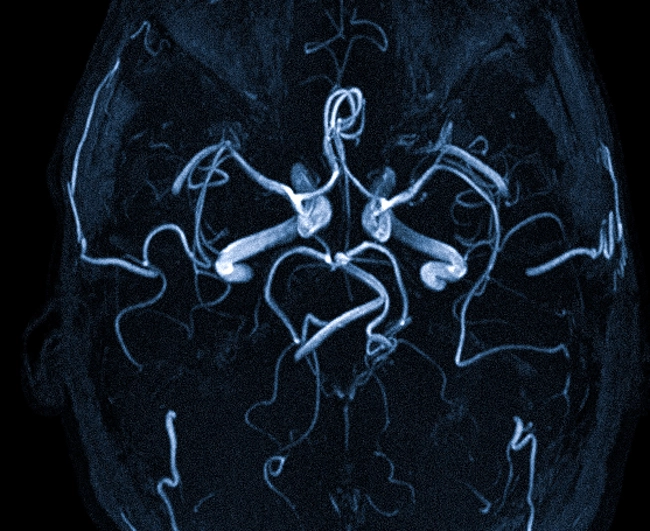 МРТ церебральных сосудов
