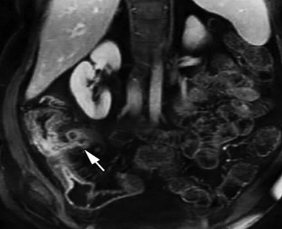 Постконтрастное МР-изображение органов брюшной полости
