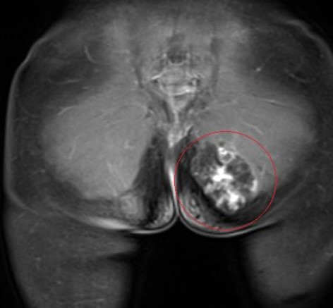 МР-скан гемангиома правой ягодицы