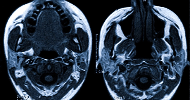 Изображение слюнных желез на МРТ