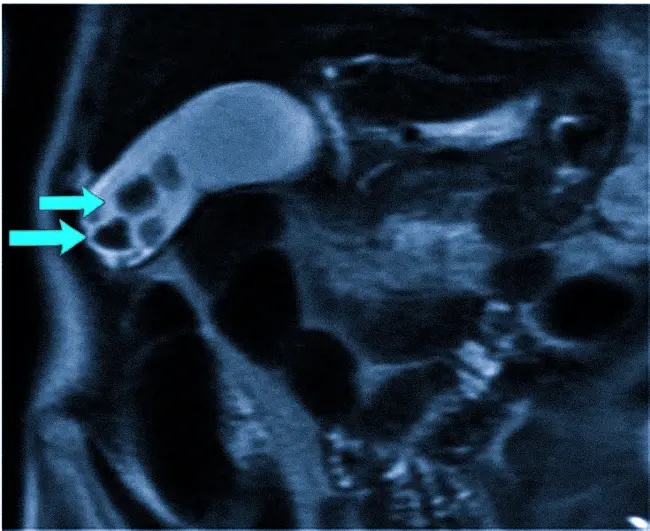 Камни на МРТ желчного пузыря 