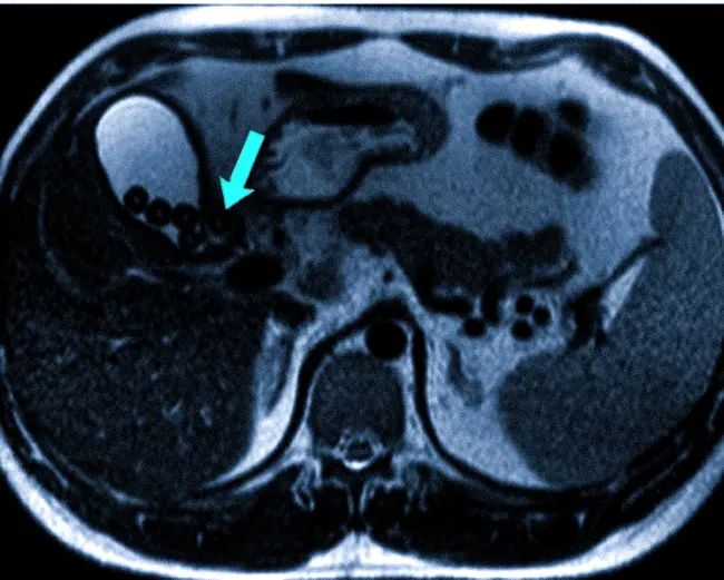 Камни на МРТ желчного пузыря 