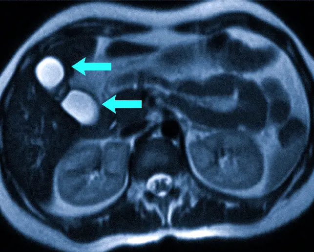 удвоение на МРТ желчного пузыря