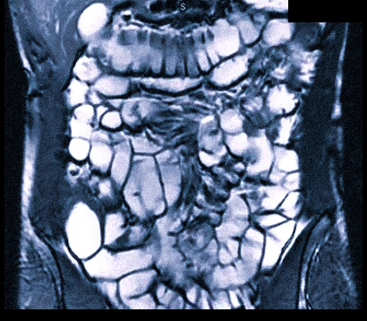 Магнитно-резонансная томография кишечника