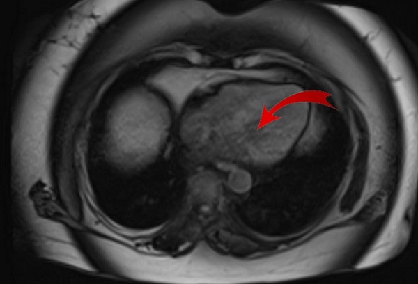 Снимок МРТ брюшной полости в аксиальной проекции, желудок указан стрелкой