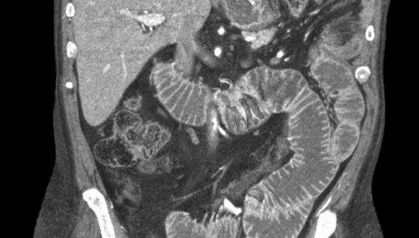 Желудочно-кишечный тракт (тонкий кишечник) на МР-томограмме