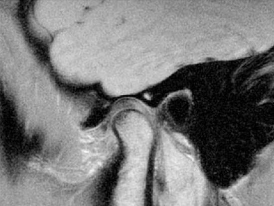 Снимок МРТ височно-нижнечелюстного сустава