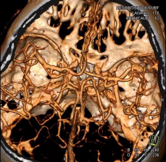 МСКТ ангиография артерий головного мозга