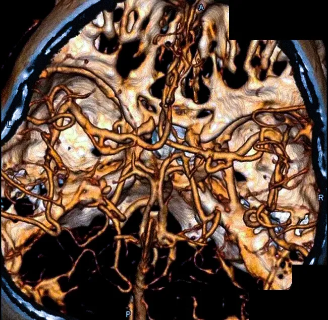 МСКТ ангиография артерий головного мозга