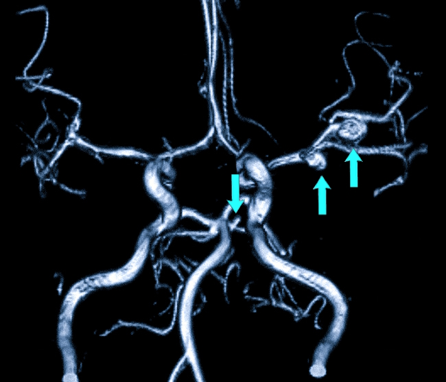 Аневризма головного мозга