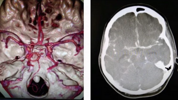 Субарахноидальное кровоизлияние на снимках МСКТ ангиографии и компьютерной томографии головного мозга